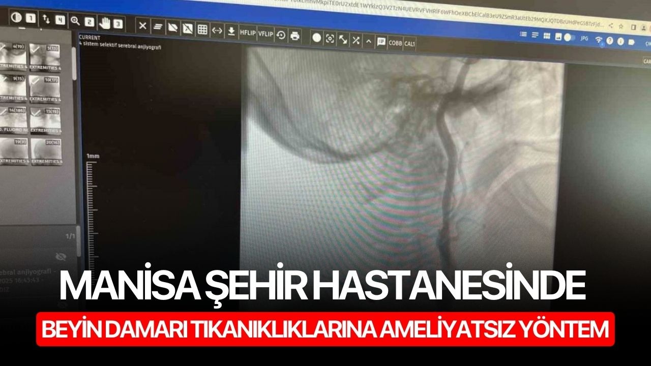 Manisa Şehir Hastanesinde Beyin Damarı Tıkanıklıklarına Ameliyatsız Yöntem