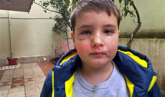 Köpek saldırısı sonrası yüzüne 60 dikiş atılan Mert, günler sonra sokağa çıktı