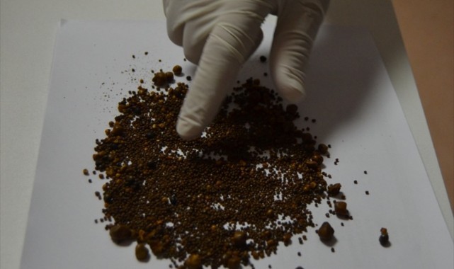 Safra kesesinden 4 bin 536 taş çıkarıldı