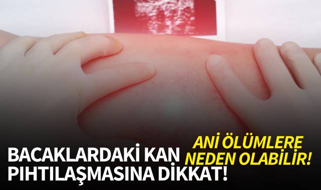 Bacaklardaki kan pıhtılaşmasına dikkat! Ani ölümlere neden olabiliyor
