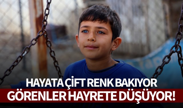 Hayata çift renk bakıyor, görenler hayrete düşüyor