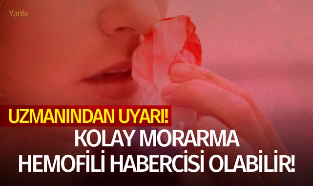 Uzmanından uyarı! Kolay morarma hemofili habercisi olabilir