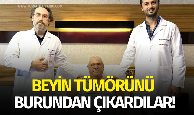Beyin tümörünü burundan çıkardılar!