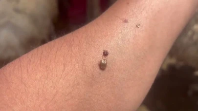 Artan kene vakaları alarm veriyor: Yaşlılar ve çocuklar tehlikede