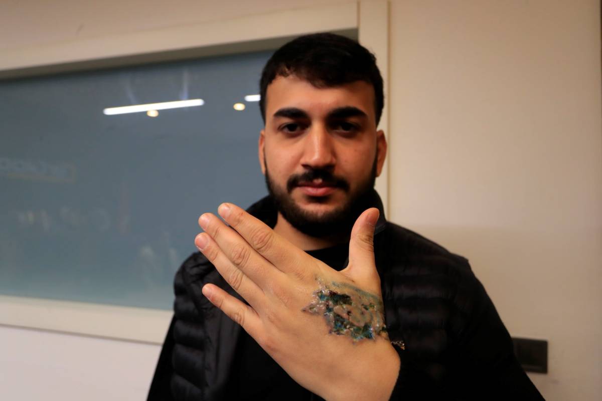 Dövmesini sildirmek istedi, dokuları öldü!