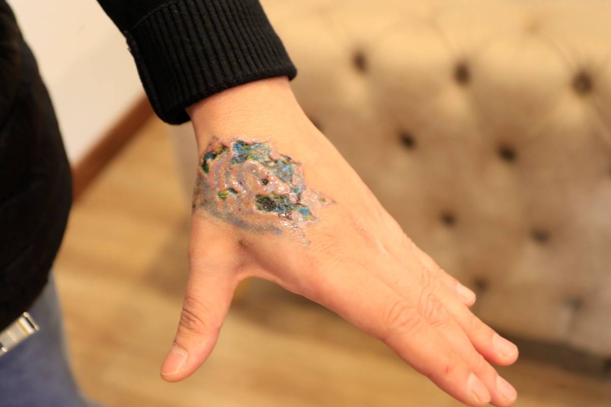 Dövmesini sildirmek istedi, dokuları öldü!